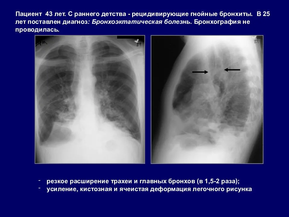 Деформированный легочный. Легочный рисунок деформирован. Деформация легочного рисунка. Легочный рисунок ячеисто деформирован. Ячеистая деформация легочного рисунка.