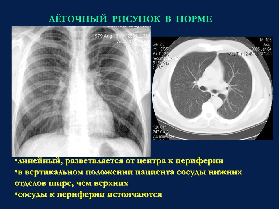 Туберкулема в верхней доле правого легкого