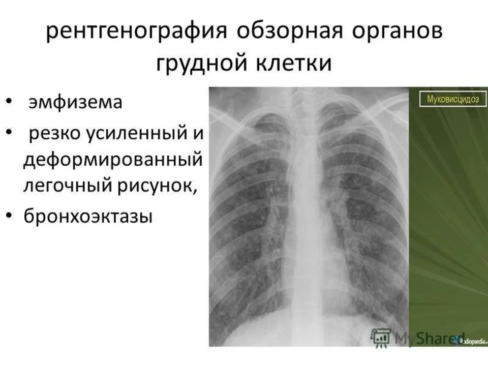 Легочный рисунок деформирован