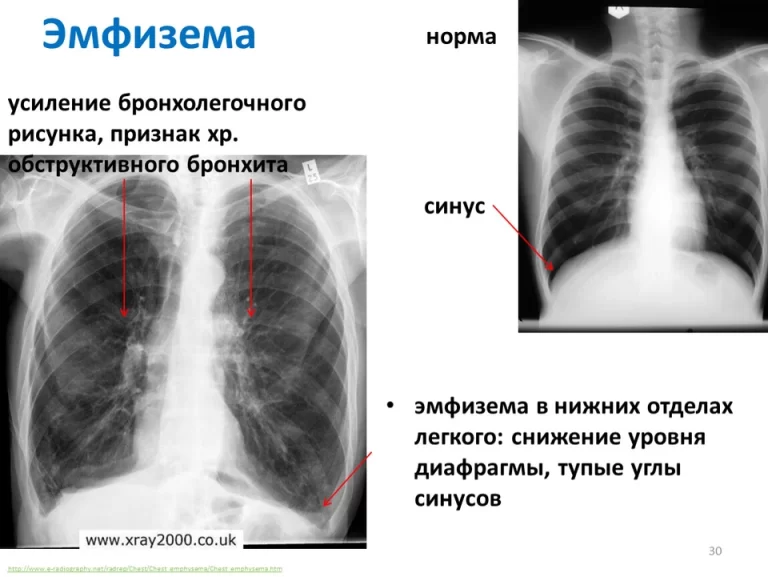 Буллезная эмфизема рентген