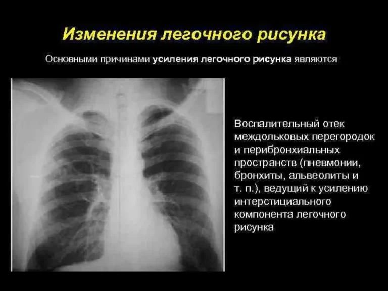Синдром изменения легочного рисунка рентген